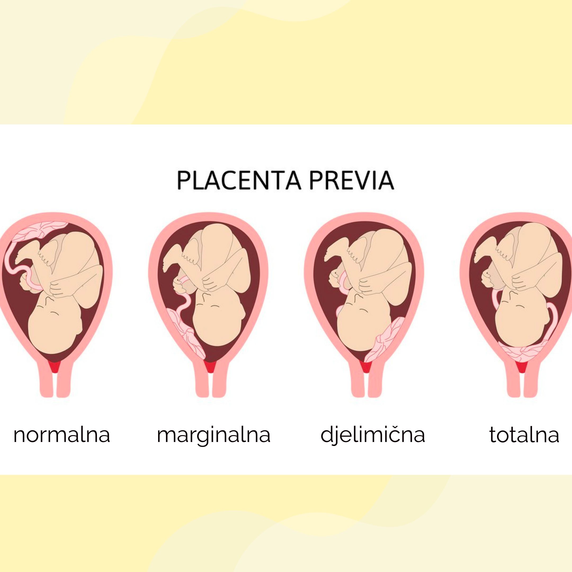 Placenta previa: Simptomi, dijagnoza i održavanje trudnoće