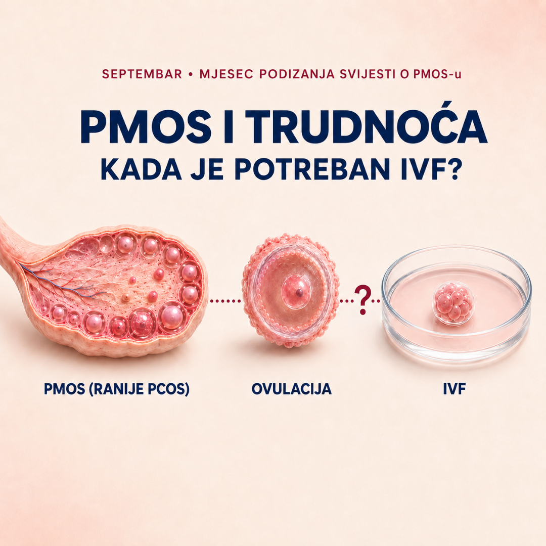 PMOS (PCOS) i trudnoća: mogu li zatrudnjeti i da li mi je potreban IVF?